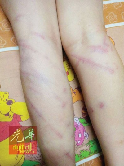 女童的手掌和腿部都被鞭至瘀伤。