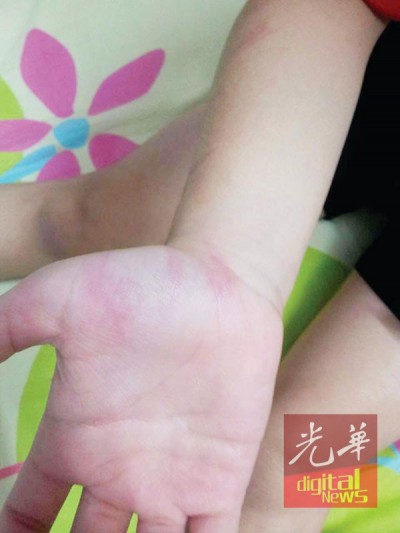 女童的手掌和腿部都被鞭至瘀伤。