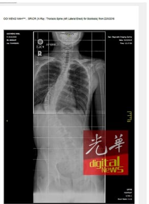 黄荣华脊椎的X光片,目前已呈68度S形弯曲。
