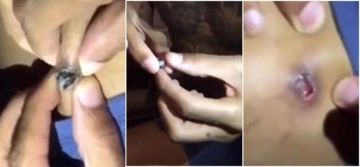取得弹过程:男子慢慢挤出子弹。子弹取出后,看得出已经发黑和变形。