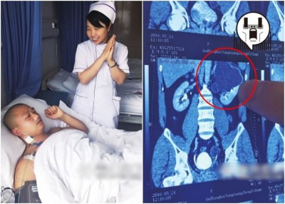 王开炼患上罕见的“重复肾”,其中左上肾(红圈示)有严重的肾积水,近日已做手术切除。