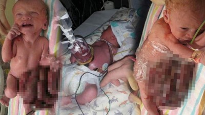 医护人员便用保鲜纸包着男婴肠脏。