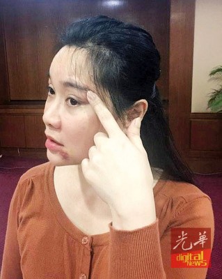 吴少梅指出眉头上遭痛殴后留下的伤疤。