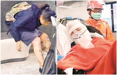 芷楠手脚严重烧伤,送院时需用氧气罩协助呼吸。