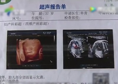 琪琪产前已进行五次4D五彩缤纷超声波检查,大夫均指一切正常。