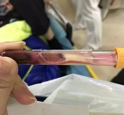 小健血糖超标逾4倍,调减出来的血液样本呈红白。