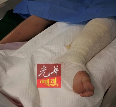 左小腿的已坏死的肌肉已经被切除。