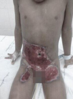男童腹部以下严重烫伤。