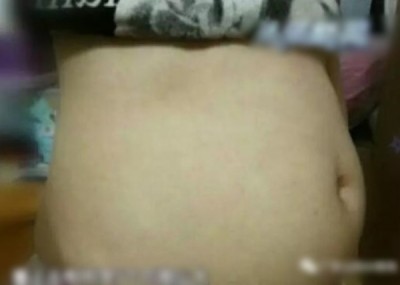 陈女肚子发胀疼痛,看上去犹如怀了5个月身孕。
