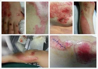 薛之谦早前被车祸,肖像中全身大面积擦伤,手臂、背部、腿部都来差档次擦伤,可为摄影师爆料仅是皮肉伤。
