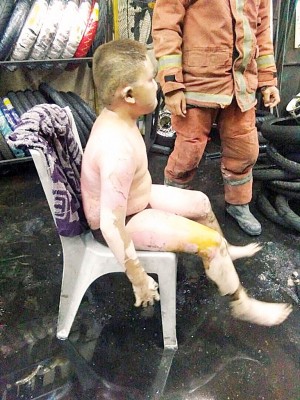 12年男童被灼伤的窝占身体20%,震惊。