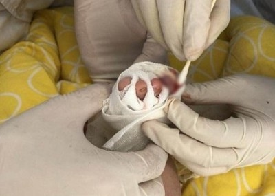 医生替男婴治疗。