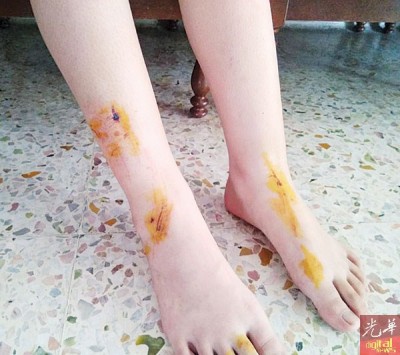 罗彩欣擦伤手脚和脸颊。
