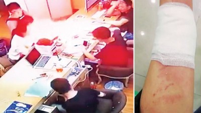 电池突然爆炸。任女的左手被炸伤。