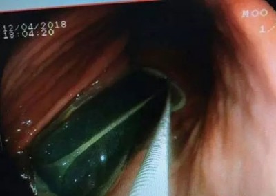 大夫透过包裹异物,下一场用钳道外和钳道内对圈套法,以该拉来体外。