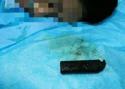 男子表示,和谐误吞该打火机已达到20充满的老。
