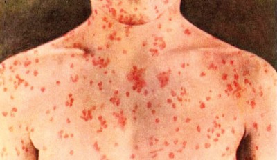 麻疹为空气、飞沫、接触传染的流行病，严重的可致命。