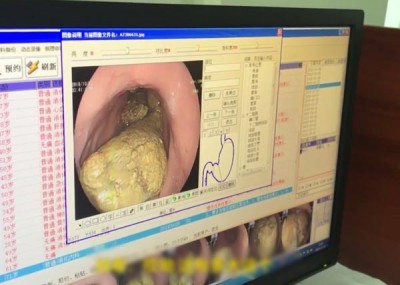 医生为老妇进行胃镜检查,发现她胃里有2个拳头般大的结石。