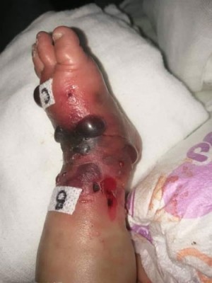 男婴左腿严重红肿、由血泡和皮肤破损。