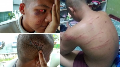 被害人的眸子及脸颊被由红肿、头被击伤缝了7针、受虐打至背部伤痕累累。(档案照)