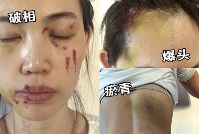 马蓉脸有血痕,轻微破相。(右上)马蓉被爆头,照片看来怵目惊心。(右下)马蓉背部也有瘀青。