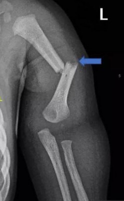 4个月大男婴28处骨头全断。