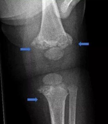 男婴膝盖骨整个断开。
