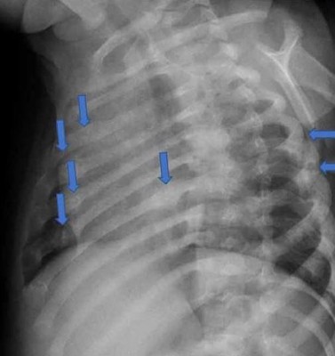 肋骨也断了不少处。