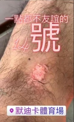晒出伤势照片。