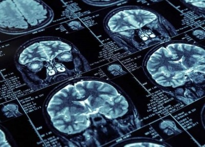 研究发现肥胖人士脑结构较正常体重人士小。