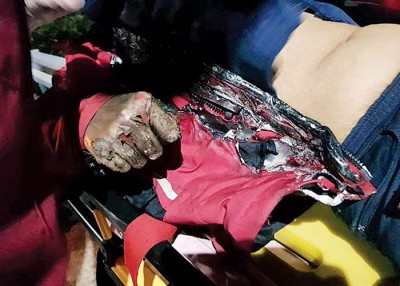 刘妇全身被二级灼伤。