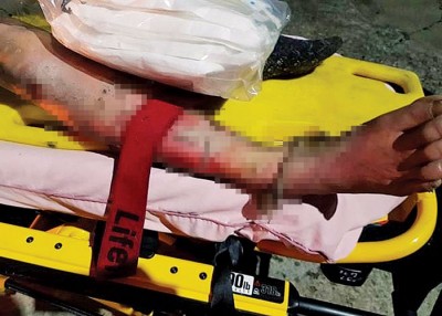 刘妇被烧至皮开肉绽。