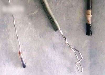 手术后钢丝及笔芯已被成功取出。