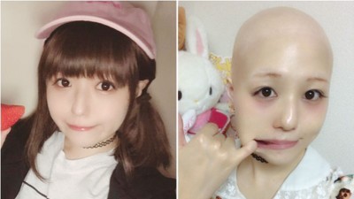 pippi坦承罹病，全身毛发1年内掉光。