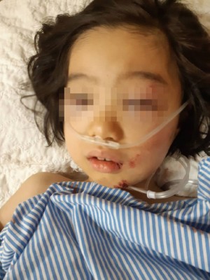 养院治疗的小语茜双眼瘀伤肿胀、下巴受伤及脸颊骨微裂。
