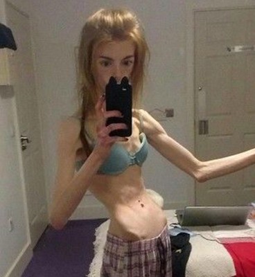 温德利曾瘦到比丧尸还恐怖。