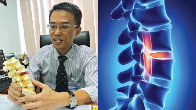 陈医生解释,椎间盘突出压迫神经线导致神经线发炎时才会造成疼痛,若只是突出但没导致发炎的话,则可能只会导致一点麻痹与肌肉酸痛。当软骨外层各种原因导致出现裂痕、再也无法完整包覆内里的胶状软骨组织时,便会产生胶状软骨组织往外移并压迫神经线,引发椎间盘突出症。