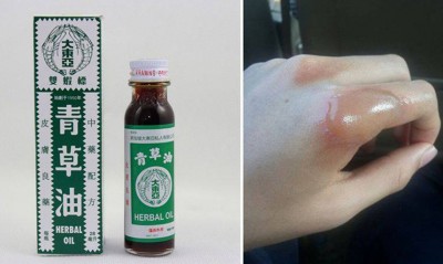 汤火烫伤