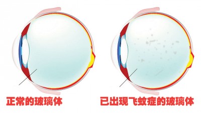 飞蚊症患者所看见的黑影,是原本清澈的玻璃体因老化等原因而开始退化及萎缩所形成的杂质的投影。