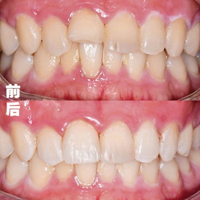 牙齿修复前后图。
