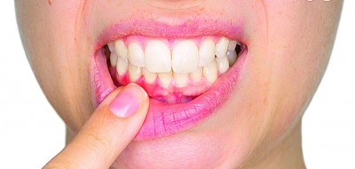 牙龈呈现淡粉红色的话，就代表健康。