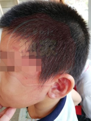 男童的左右脸颊被哥哥掌掴至红肿。